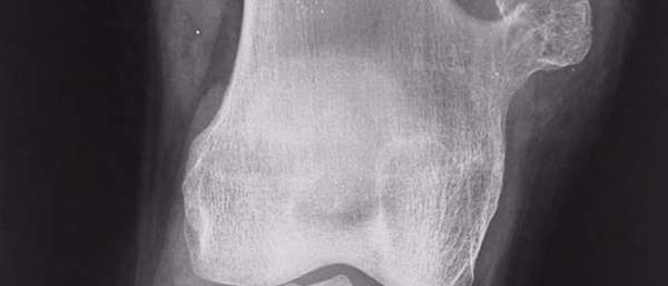 Экзостоз коленного сустава у детей операция